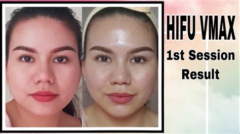 vmax hifu vs hifu|I Tried VMAX and here's the result!.